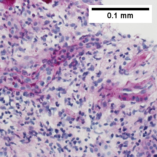 PAS without diastase showing acutely inflamed bile duct, with accompanying blood vessel of similar size, diagnostic of acute cholangitis (400X).