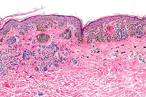 junctional melanocytic nevus