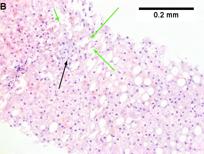 Changes of steatohepatitis and interface hepatitis, with granuloma. Patient with diabetes was ANA, AMA, HCV, HBV negative, without drugs known to produce granulomas or interface hepatitis. This may be a case of AMA negative primary biliary cirrhosis, but studies to determine that with certainty were not performed.