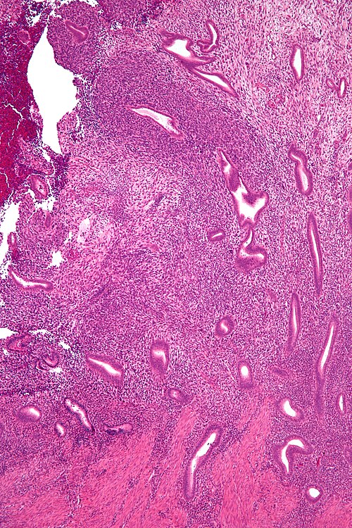 Uterine adenosarcoma - low mag.jpg