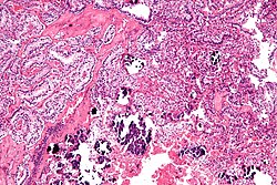 TFE3-rearranged renal cell carcinoma - Libre Pathology