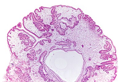 Gastric juvenile polyp - very low mag.jpg