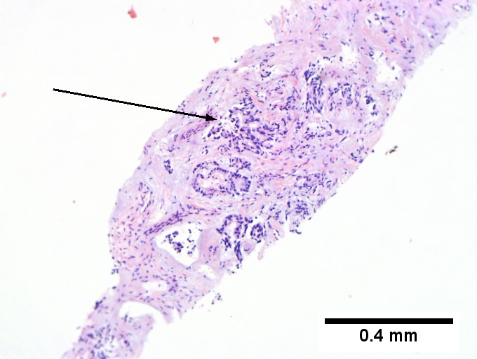 Cholangiocarcinoma, intrahepatic, small duct type.