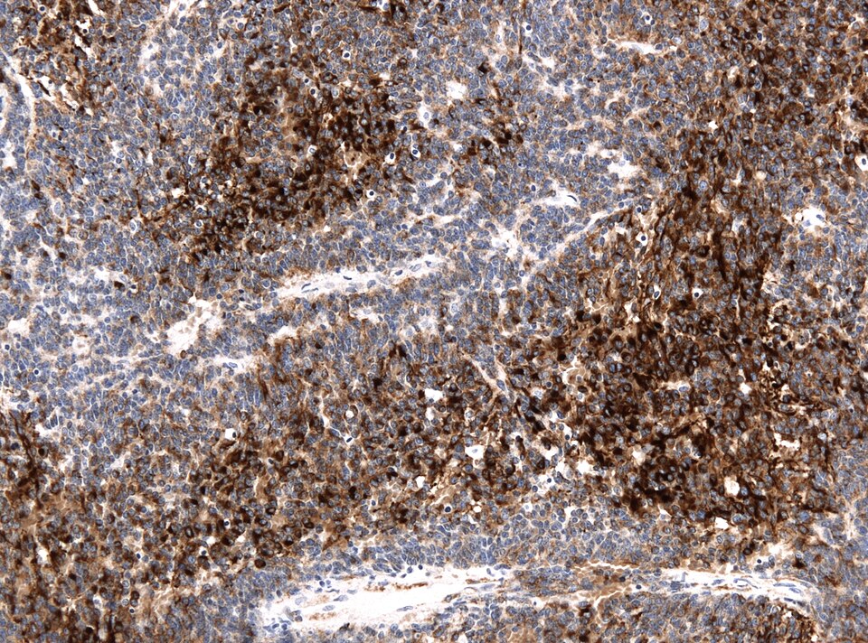 File:Medulloblastoma MAP2 IHC.jpg