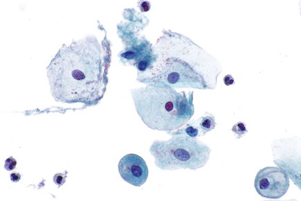 Parabasal cells - Pap test - 3 -- very high mag.jpg