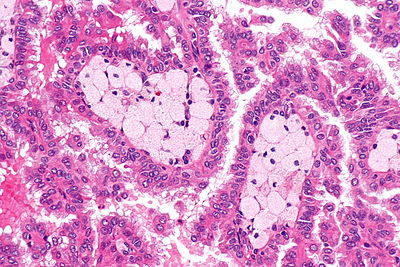 Papillary renal cell carcinoma -- very high mag.jpg