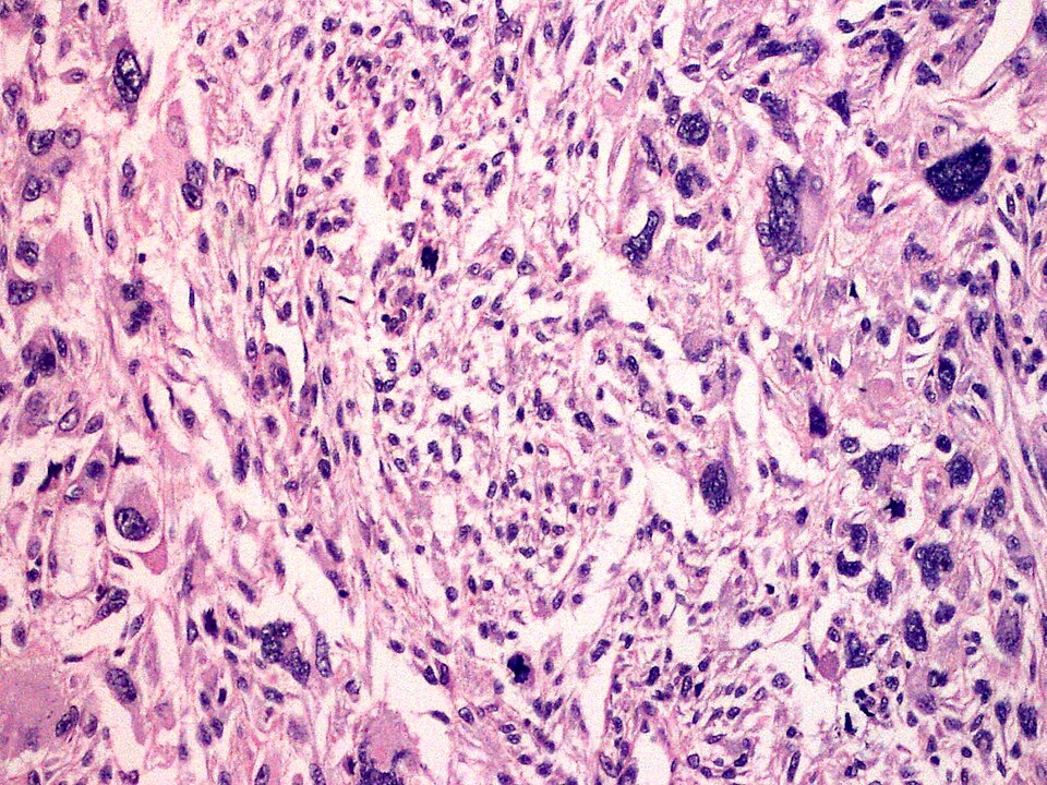 File:SkinTumors-P9280874.jpg