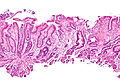 Gastric antral vascular ectasia - 2 - intermed mag.jpg