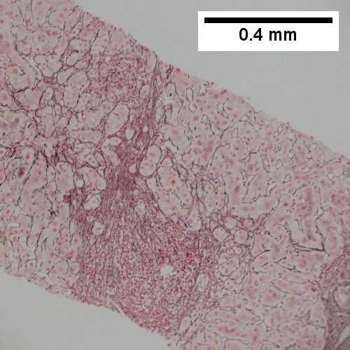 Reticulin with extensive piecemeal necrosis (100X).
