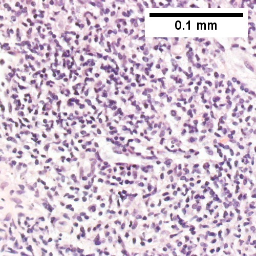 Proof is at high power. All cells are similar to macrophages but are too closely crowded to be macrophages. The monomorphism (one type of cell) should inspire immunohistochemical stains, which showed the patient had a B cell lymphoma.
