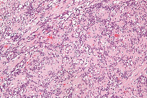 Intranodal palisaded myofibroblastoma - high mag.jpg