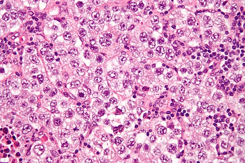 Seminoma high mag.jpg