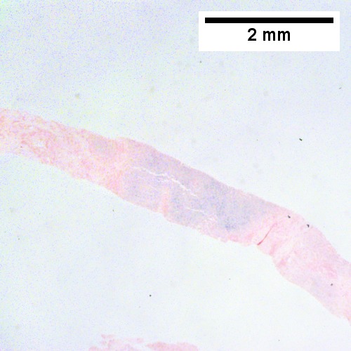 Iron stain shows 4+ iron, identifiable at the lowest magnification, as well by naked eye (Row 1 Right 20X)