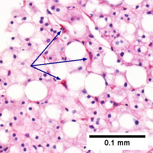 PAS with diastase shows PAS-D Kupffer cells (arrows) (Row 2 Right 400X).