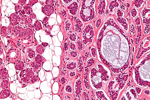 Adenoid cystic carcinoma - high mag.jpg