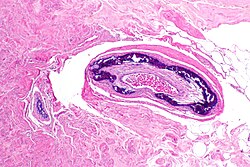 Medial calcific sclerosis - Libre Pathology