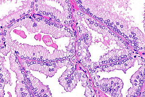 prostatic adenocarcinoma conventional/ acinar type Levitra a prosztatitis