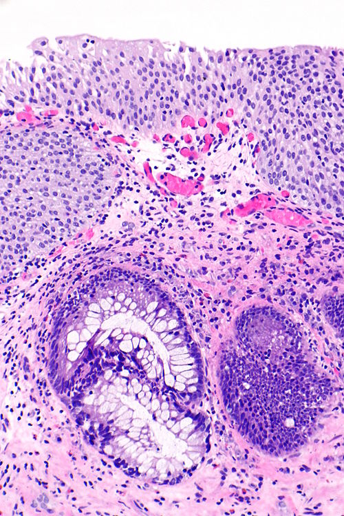 Cystitis cystica et glandularis -- intermed mag.jpg