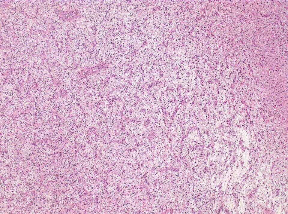 File:Neuropathology case V 01.jpg