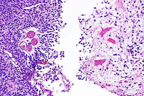 Plasmacytoid urothelial carcinoma -- intermed mag.jpg