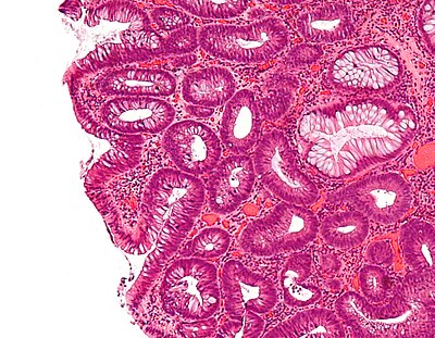 Tubular adenoma 4 high mag.jpg