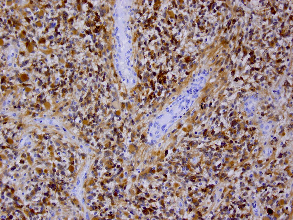 File:IDH1 GBM 20x.jpg