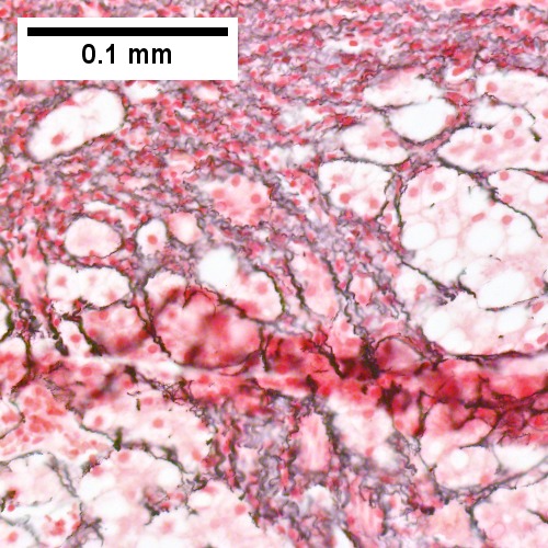 Reticulin shows black lines about hepatocytes, indicating confluent piecemeal necrosis (Row 3 Right 400X).