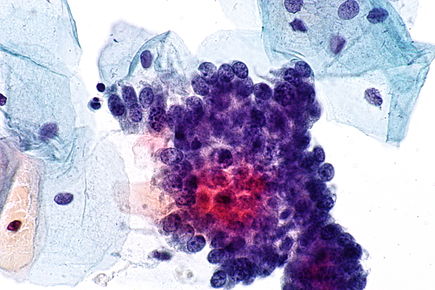 Endocervical adenocarcinoma in situ - cyto - alt -- very high mag.jpg