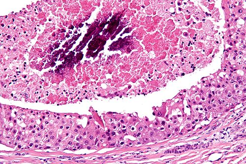 Salivary duct carcinoma - high mag.jpg