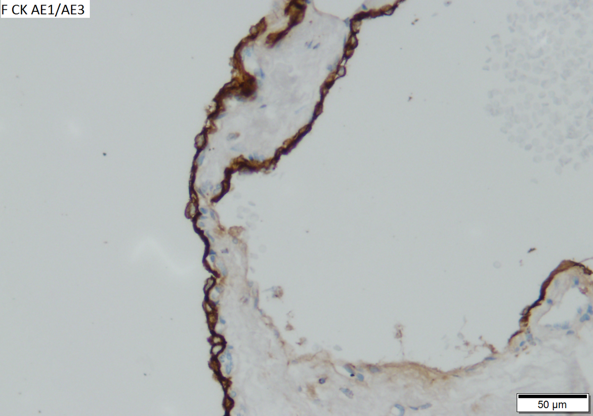 Microcystic serous cystadenoma of pancreas