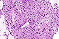 Hürthle cell neoplasm - Libre Pathology