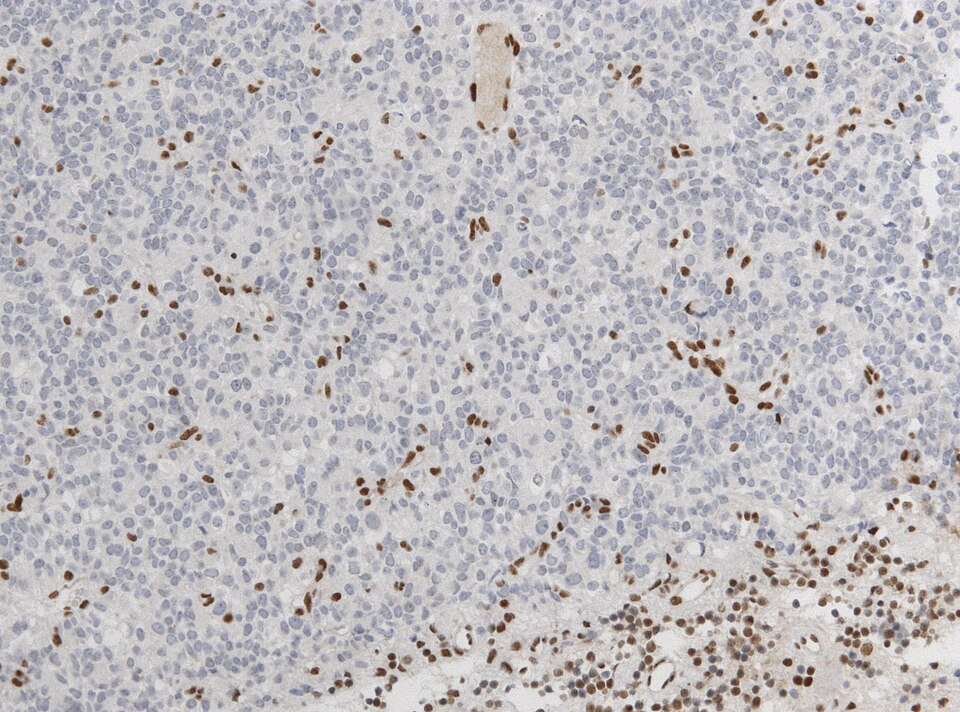 File:Neuropathology case IV 04.jpg