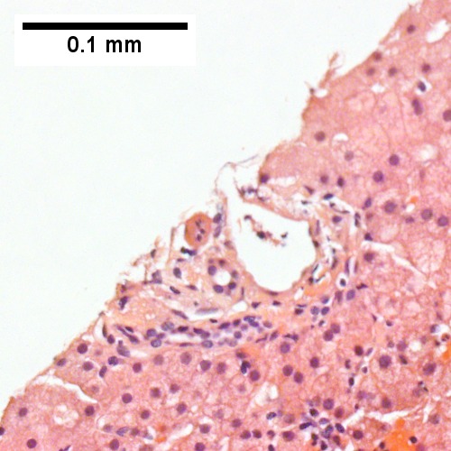 A triad with a proliferated bile ductule, otherwise normal (Row 1 Right 400X).