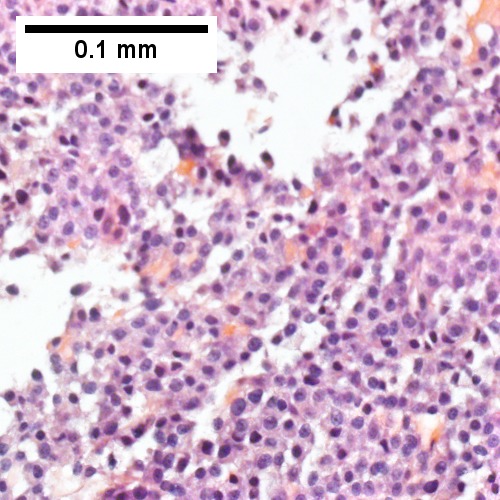 Tumor cells showed round to ovoid nuclei without pattern and with grey cytoplasm that proved to be CD138 positive (Row 2 Right 400X).