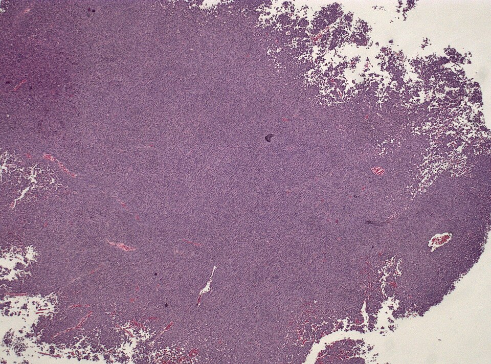 File:Neuropathology case VII 01.jpg