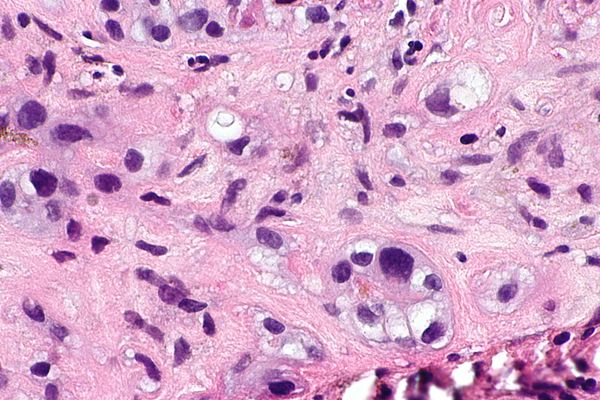 Placental site nodule - Libre Pathology