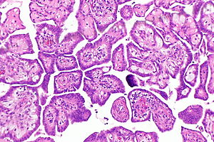 Well-differentiated papillary mesothelioma - Libre Pathology