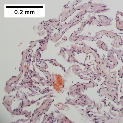 Cavernous hemangioma with flat, non-atypical endothelium (200X).