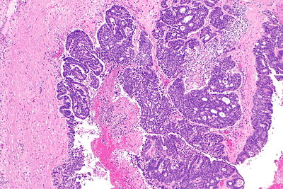 Metastatic adenocarcinoma involving the kidney -- low mag.jpg