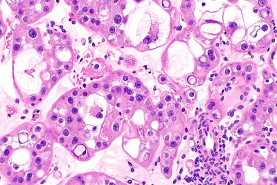 Hybrid tumour of the kidney -- high mag.jpg