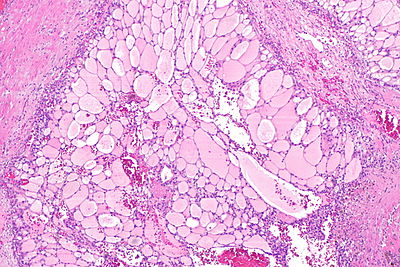 Unclassified renal cell carcinoma - thyroid-like with myomatous stroma -- low mag.jpg