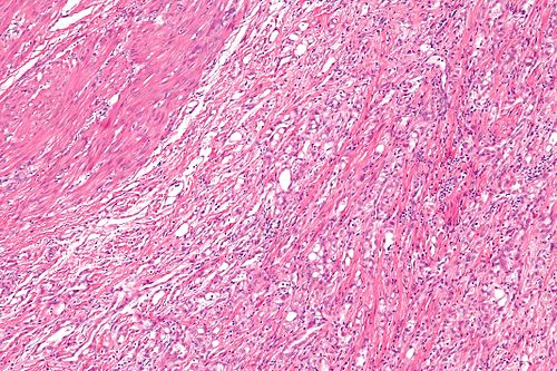 Adenomatoid tumour - intermed mag.jpg