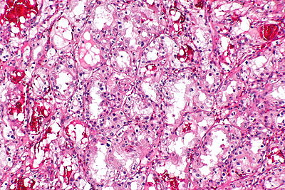 Clear cell renal cell carcinoma -- intermed mag.jpg