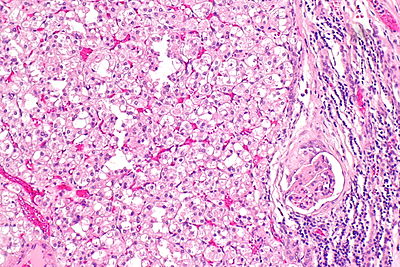 SDH-deficient renal cell carcinoma - alt - intermed mag.jpg