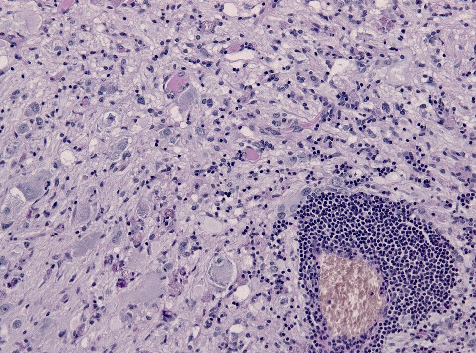File:Ganglioglioma lymphocytic cuffing PAS.jpg