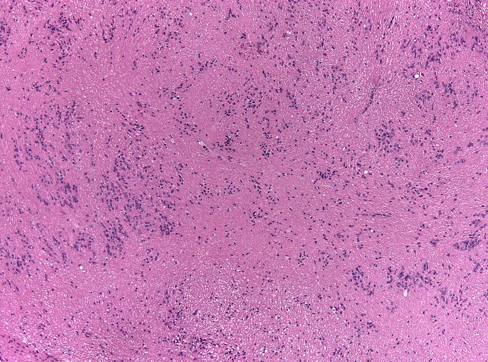 File:Subependymoma HE x40.jpg