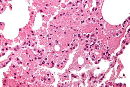 Pulmonary alveolar proteinosis - very high mag.jpg