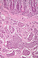 neuroendocrine tumour intermed intestines histopathology intestine nephron mb neoplasms