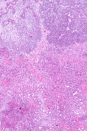 Carcinoma ex pleomorphic adenoma - a1 -- low mag.jpg