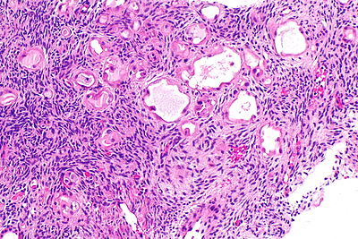 Mixed epithelial stromal tumour of kidney -- intermed mag.jpg